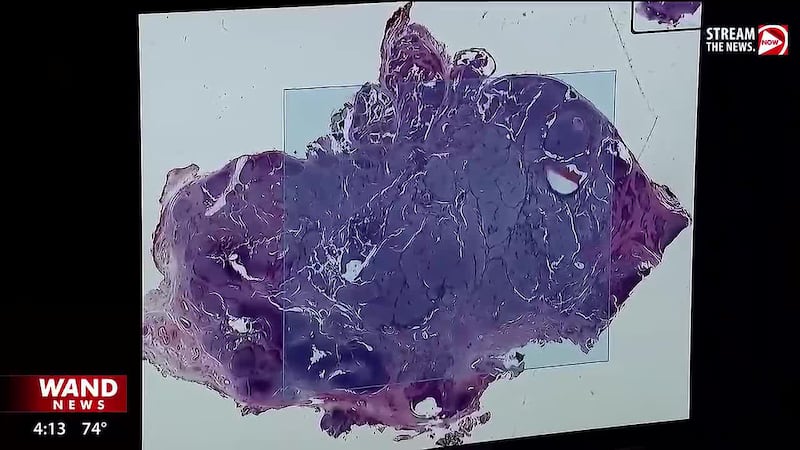 Doctors have started to use personalized AI technology to help treat cancer patients.